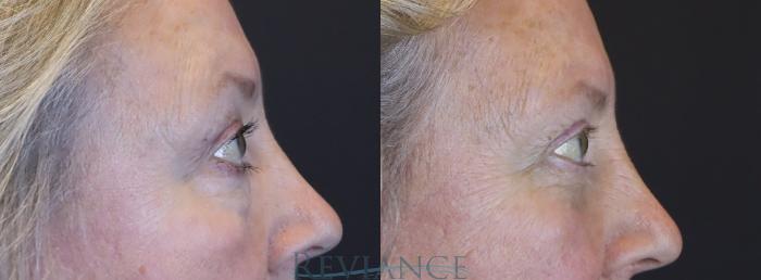 66 yo female bothered by lower eyelid fat pockets