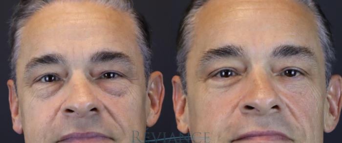 54 yo male bothered by the heaviness of his undereye area. He underwent lower blepharoplasty with skin pinch followed by CO2 laser resurfacing of the undereye area