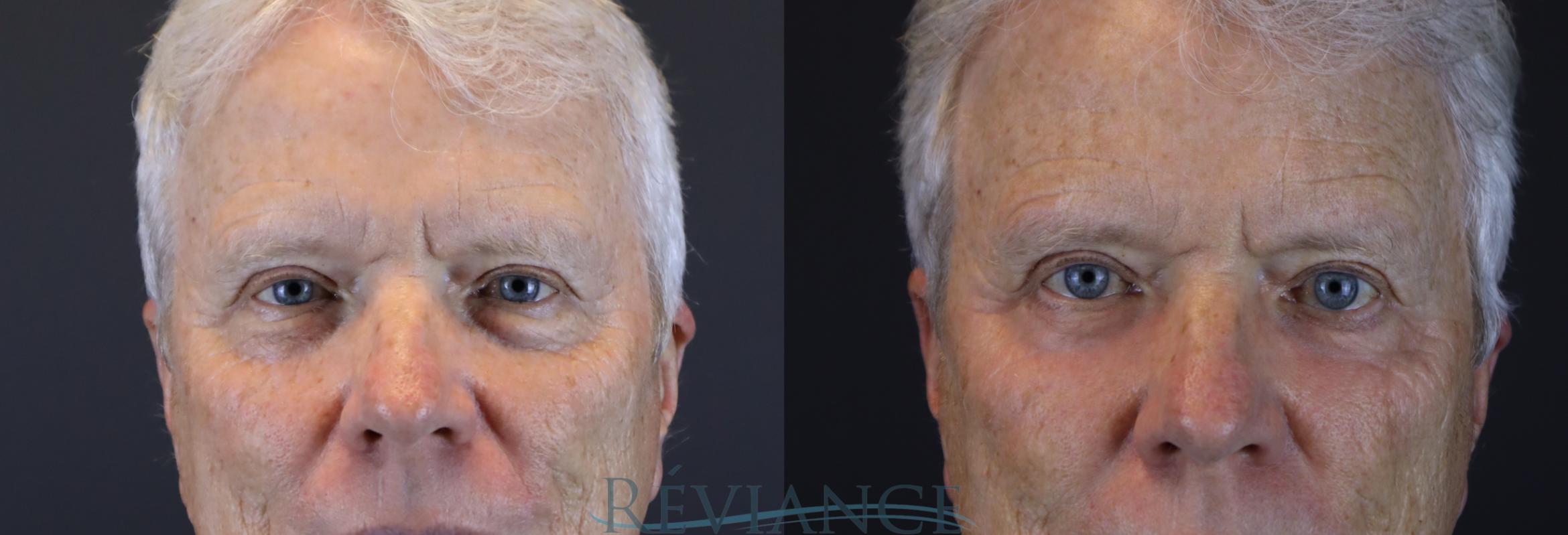 Before lower blepharoplasty, skin pinch with partial CO2