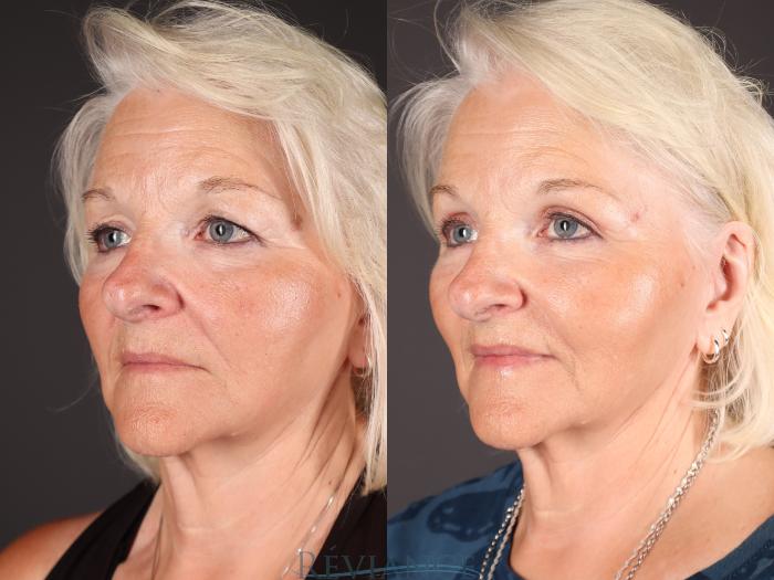 Before & After Eyelid Surgery Case 2230 1/4 View in Portland, OR