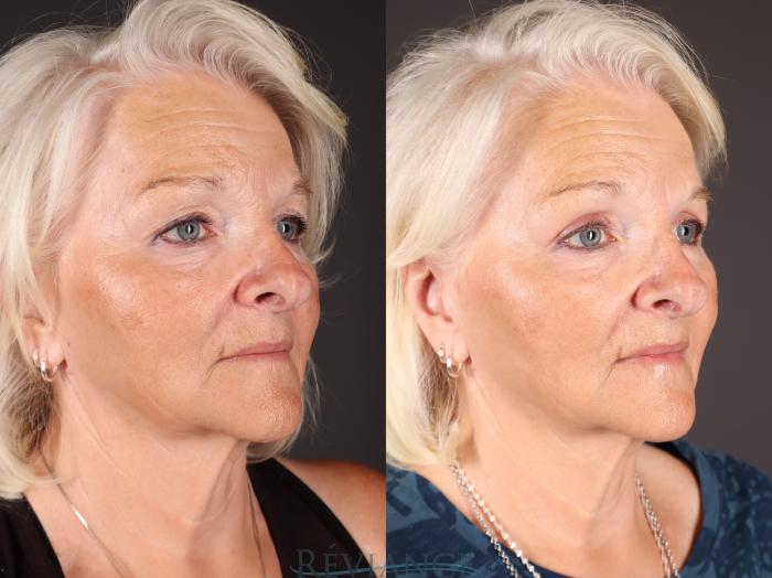 Before & After Eyelid Surgery Case 2230 3/4 View in Portland, OR