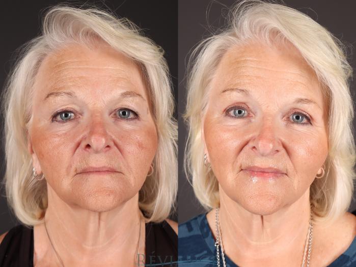 Before & After Eyelid Surgery Case 2230 Front View in Portland, OR