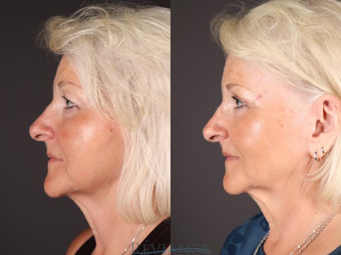 Before & After Eyelid Surgery Case 2230 Left Side View in Portland, OR