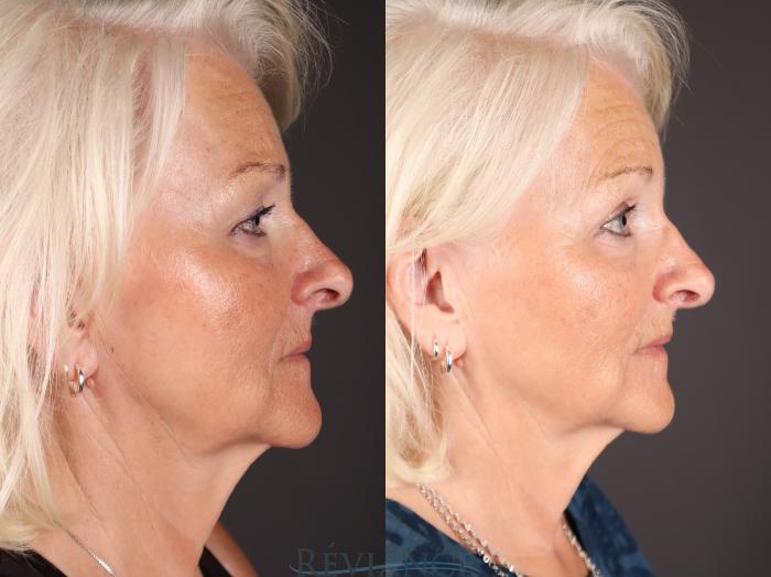 Before & After Eyelid Surgery Case 2230 Right Side View in Portland, OR