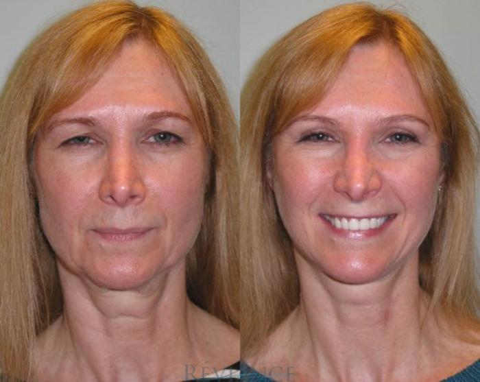 Before & After Facelift Case 101 View #1 View in Portland, OR
