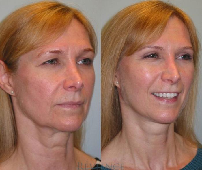 Before & After Facelift Case 101 View #2 View in Portland, OR