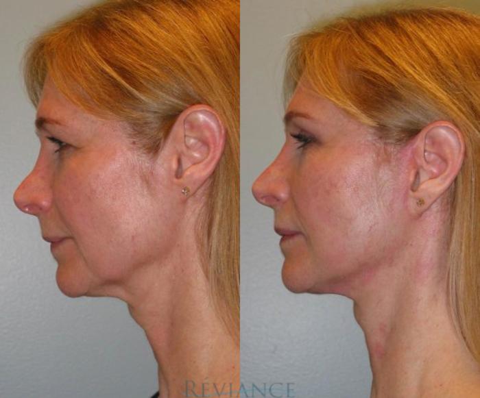 Before & After Facelift Case 101 View #3 View in Portland, OR