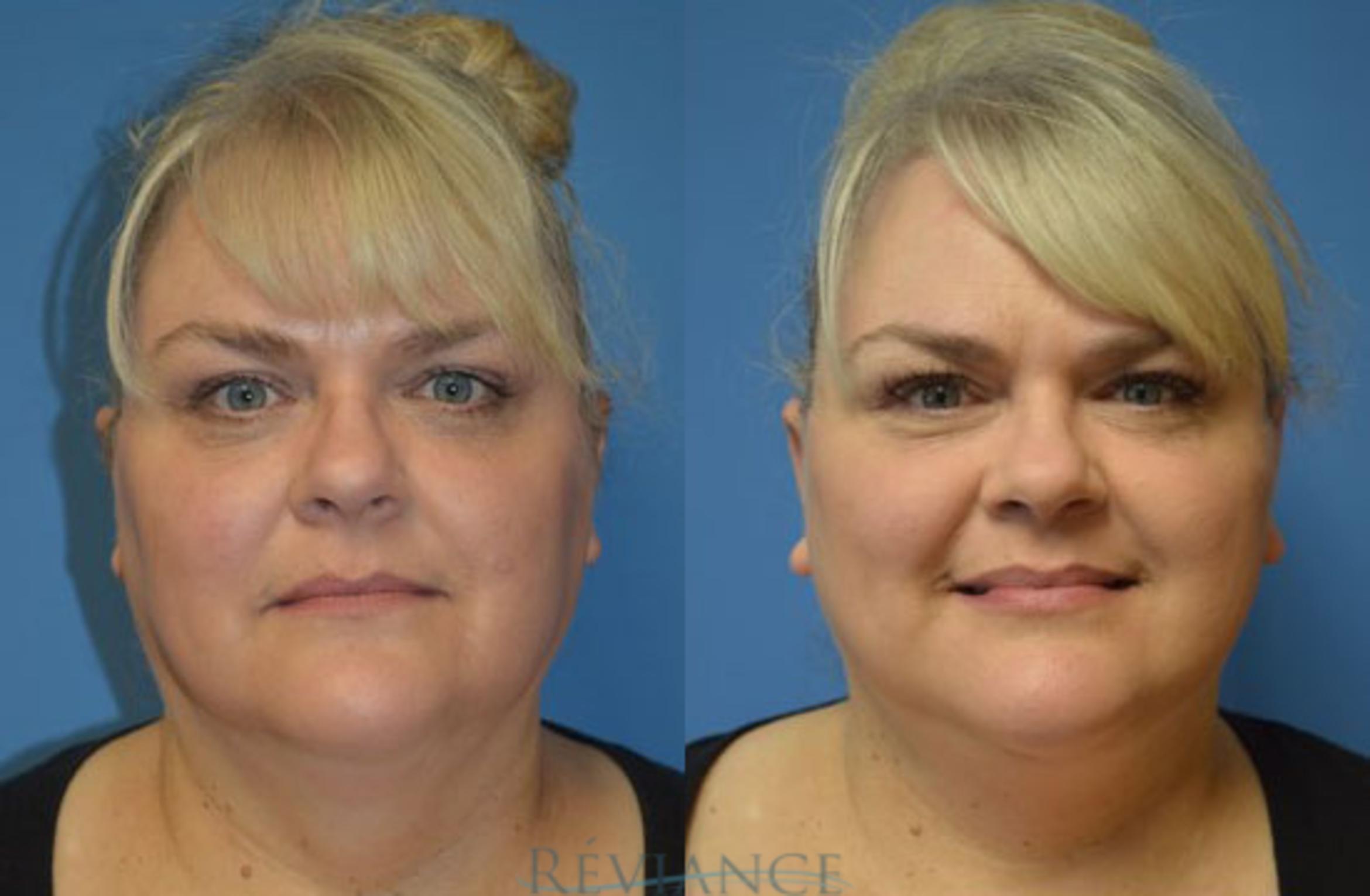 Before & After Facelift Case 1241 View #1 View in Portland, OR