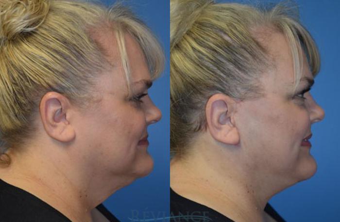 Before & After Facelift Case 1241 View #2 View in Portland, OR