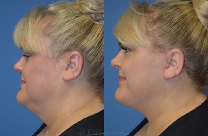 Before & After Facelift Case 1241 View #3 View in Portland, OR