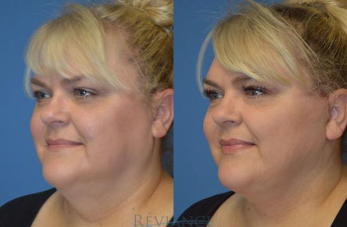 Before & After Facelift Case 1241 View #4 View in Portland, OR