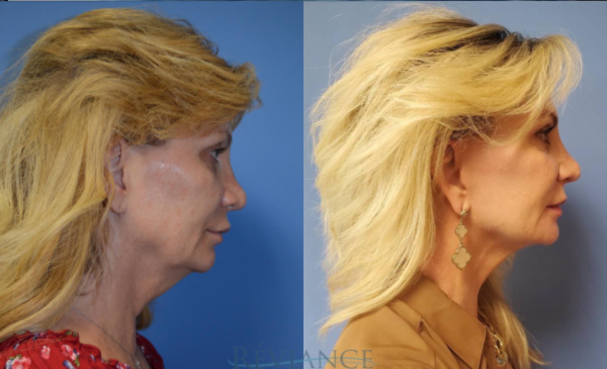 Before & After Facelift Case 1386 View #1 View in Portland, OR