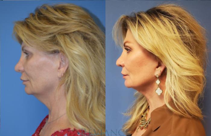 Before & After Facelift Case 1386 View #2 View in Portland, OR