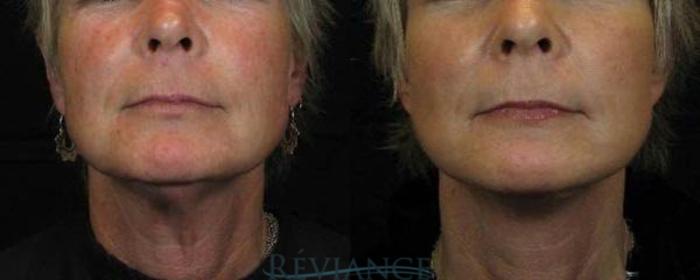 Before & After Facelift Case 2200 Front View in Portland, OR