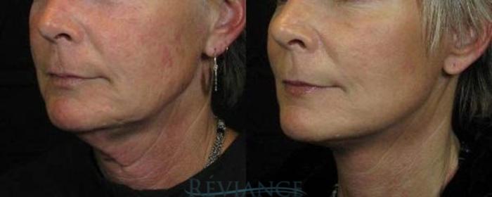 Before & After Facelift Case 2200 Left Oblique View in Portland, OR