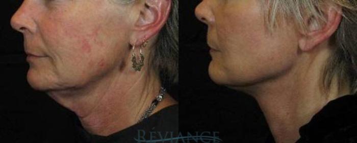 Before & After Facelift Case 2200 Left Side View in Portland, OR