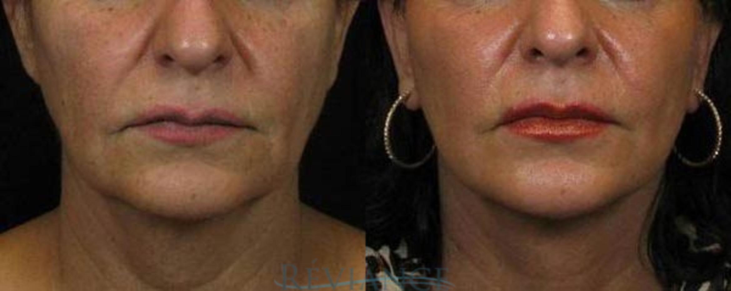 Before & After Facelift Case 2203 Front View in Portland, OR