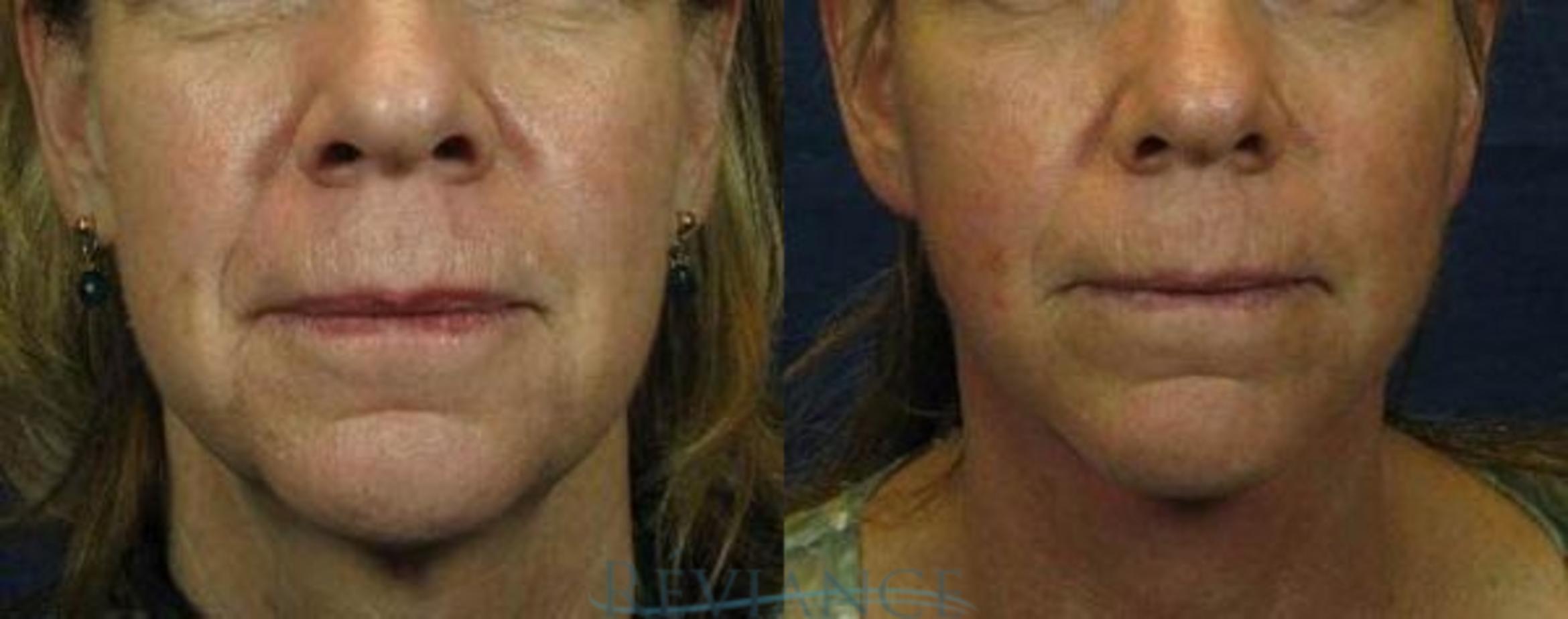 Before & After Facelift Case 2204 Front View in Portland, OR