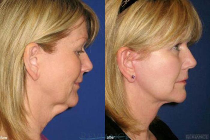 Before & After Facelift Case 2205 Right Side View in Portland, OR