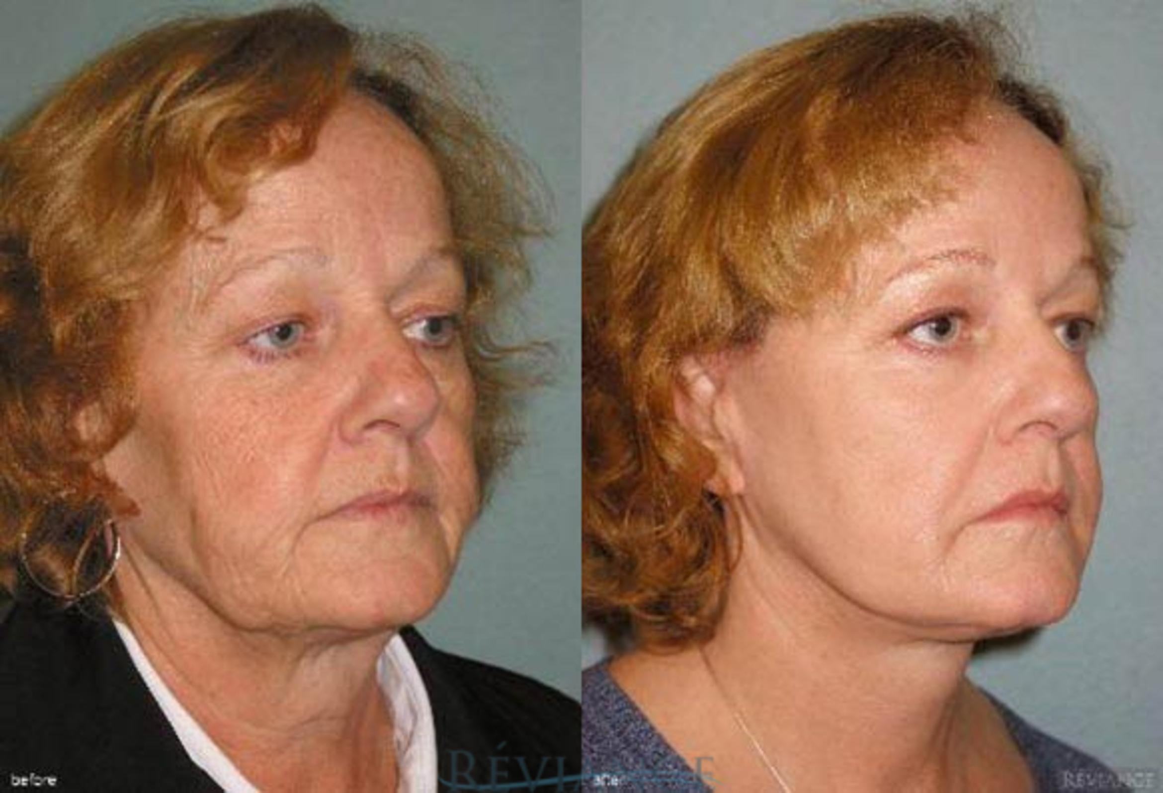 Before & After Facelift Case 2206 Right Oblique View in Portland, OR