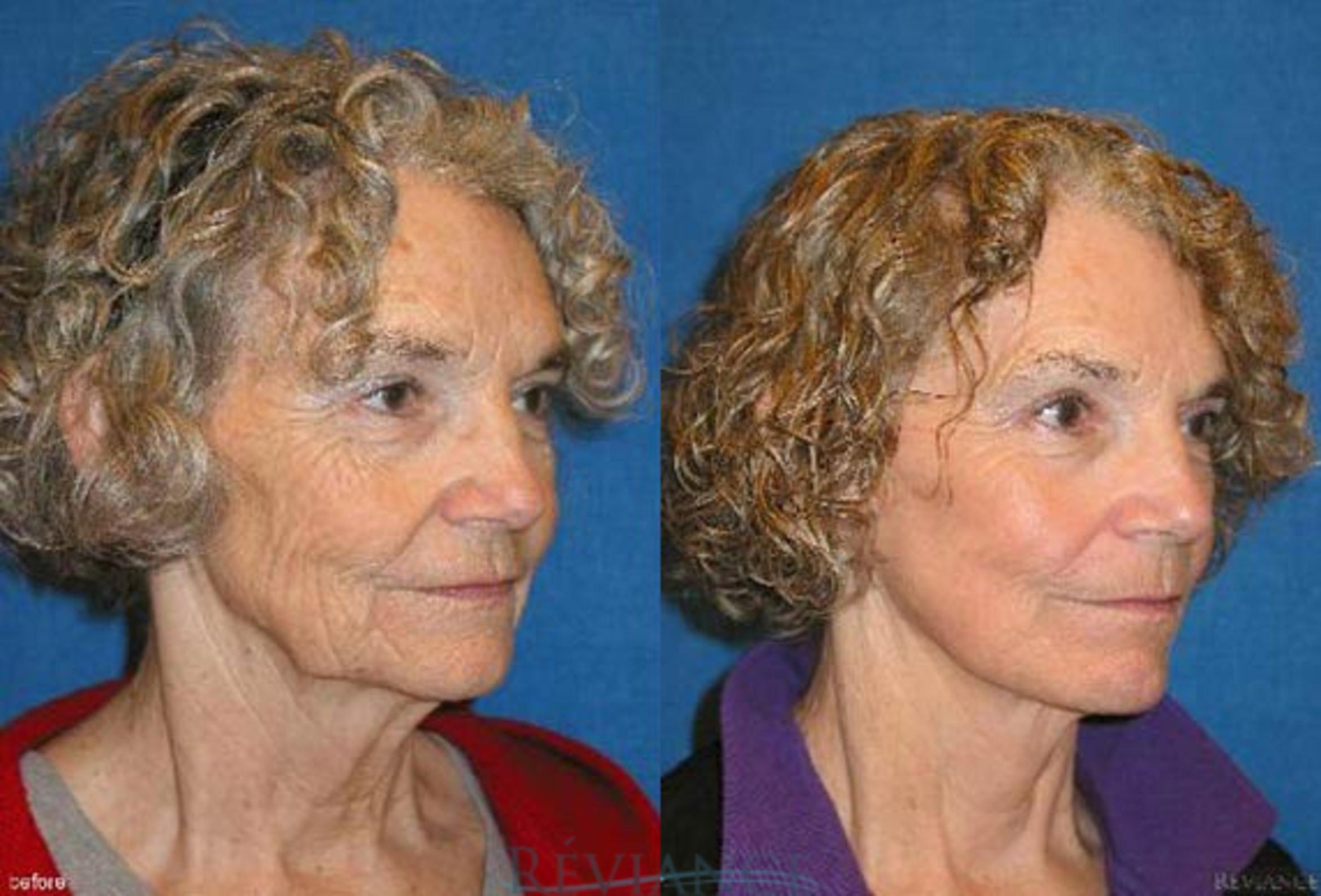 Before & After Facelift Case 2207 Right Oblique View in Portland, OR