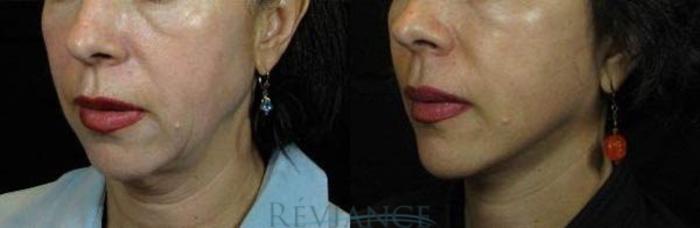 Before & After Facelift Case 2208 Left Oblique View in Portland, OR
