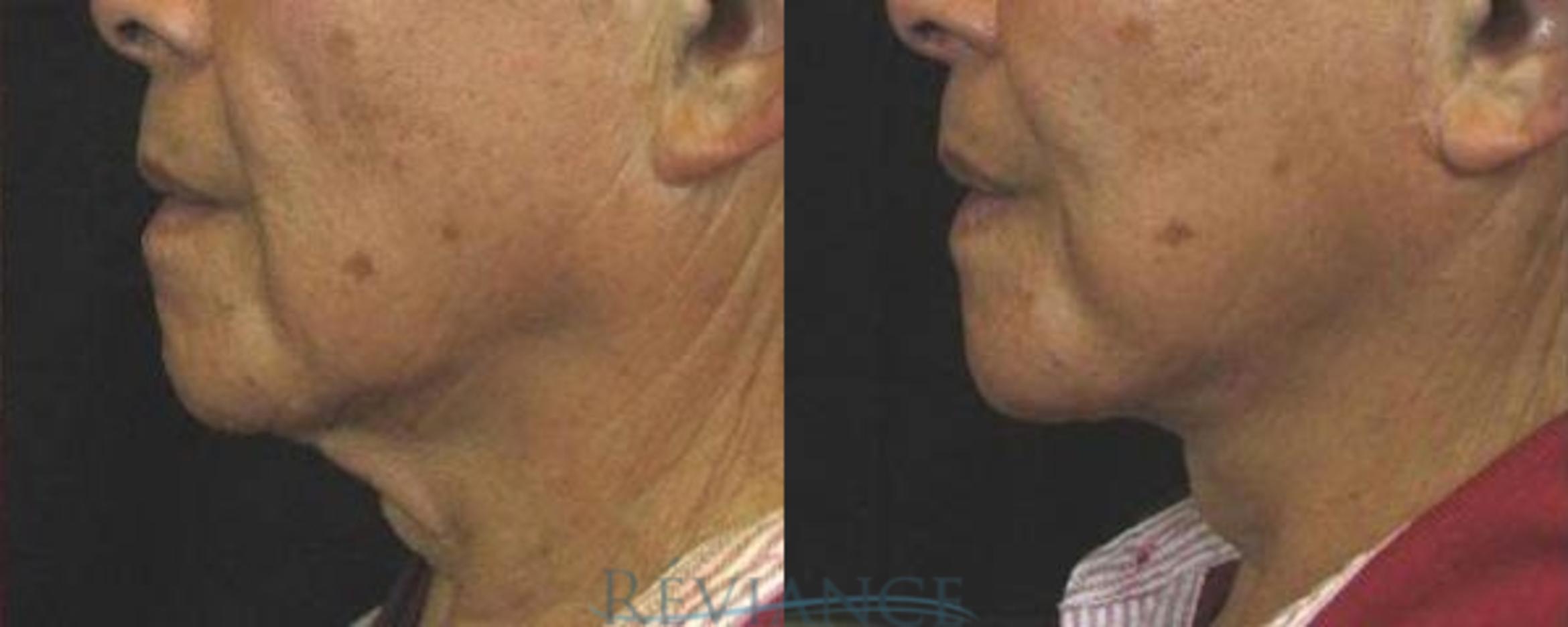 Before & After Facelift Case 2209 Left Side View in Portland, OR