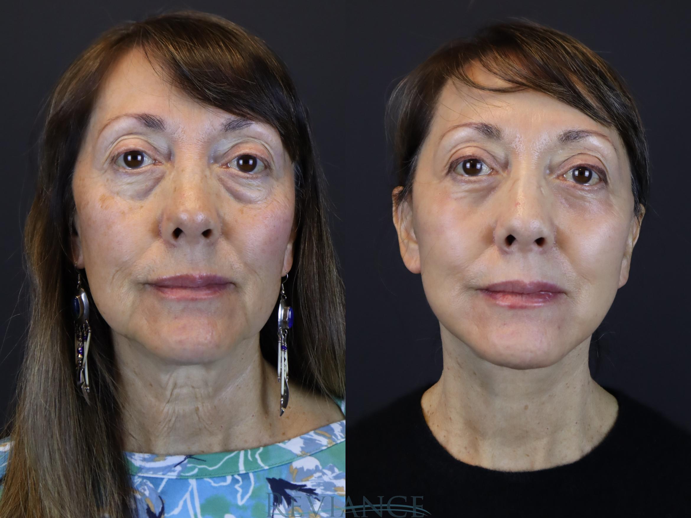 Facelift, CO2 laser, Lower eyelid blepharoplasty