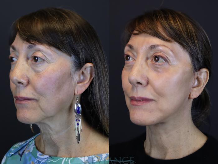 Deep Plane Facelift, CO2 Laser resurfacing, Lower blepharoplasty