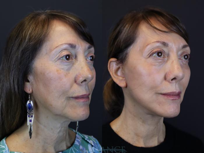 Deep Plane Facelift, CO2 Laser resurfacing, Lower blepharoplasty