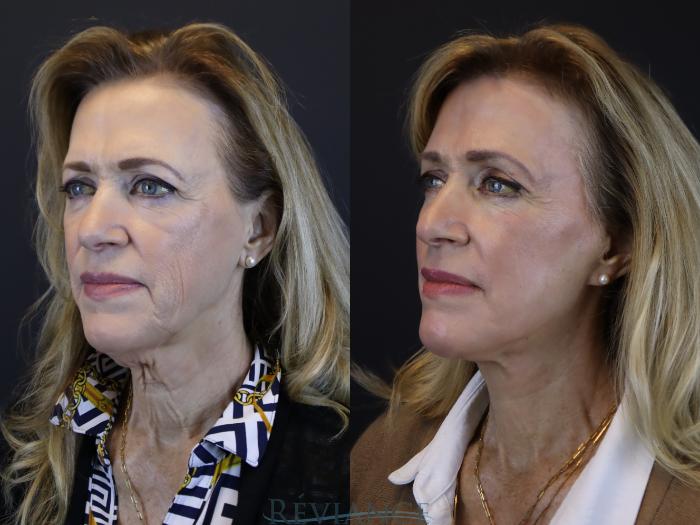 Before & After Facelift Case 2220 Left Oblique View in Portland, OR