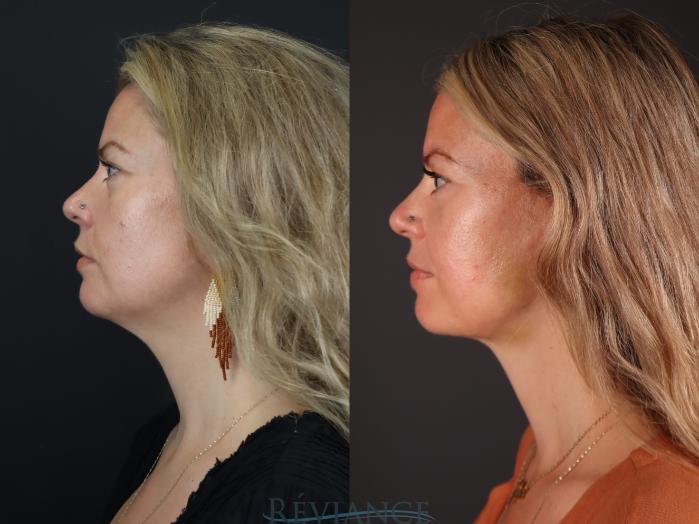 Before & After Facelift Case 2227 Left Side Profile View in Portland, OR