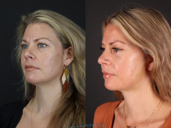 Before & After Facelift Case 2227 Left Side View in Portland, OR