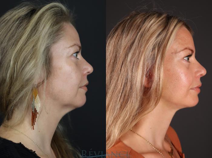 Before & After Facelift Case 2227 Right Side Profile View in Portland, OR
