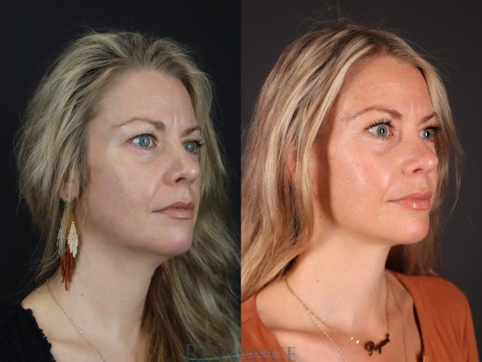 Before & After Facelift Case 2227 Right Side View in Portland, OR