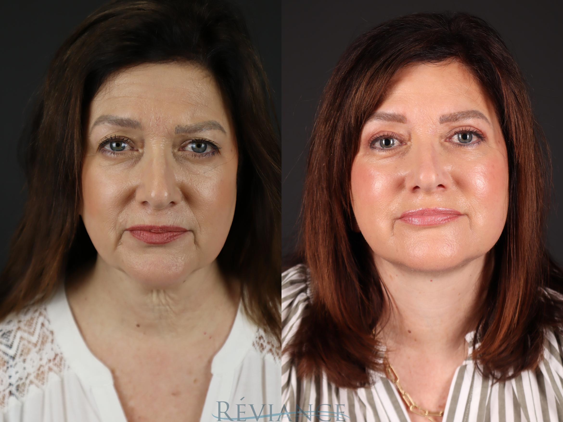 Before & After Facelift Case 2228 Front View in Portland, OR