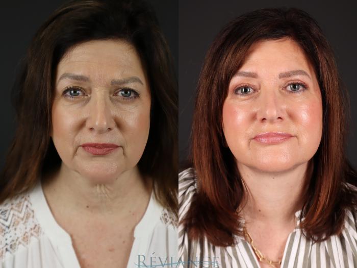 Before & After Facelift Case 2228 Front View in Portland, OR