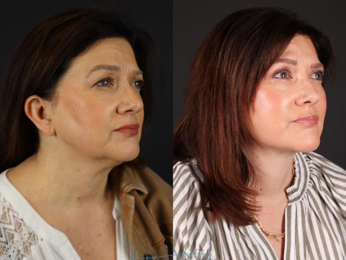Before & After Facelift Case 2228 Left Oblique View in Portland, OR