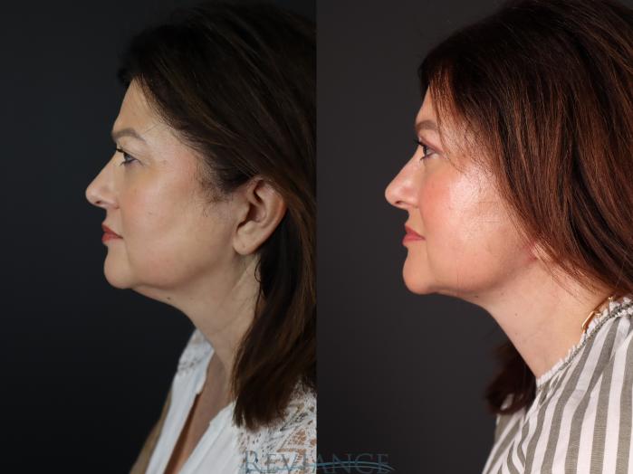 Before & After Facelift Case 2228 Left Profile View in Portland, OR