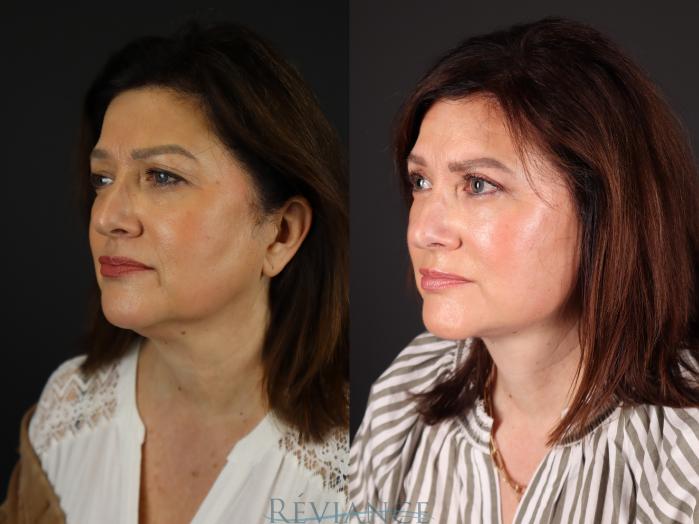 Before & After Facelift Case 2228 Left Side View in Portland, OR