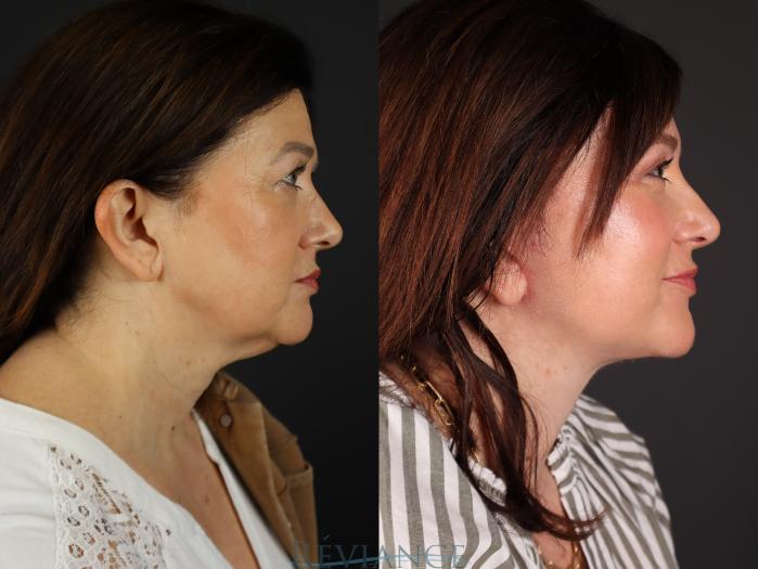 Before & After Facelift Case 2228 Right Profile View in Portland, OR