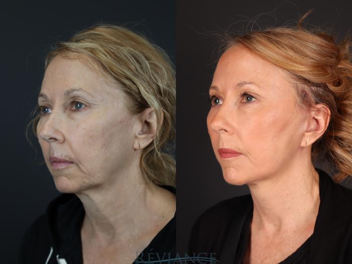 Before & After Facelift Case 2229 1/4 View in Portland, OR