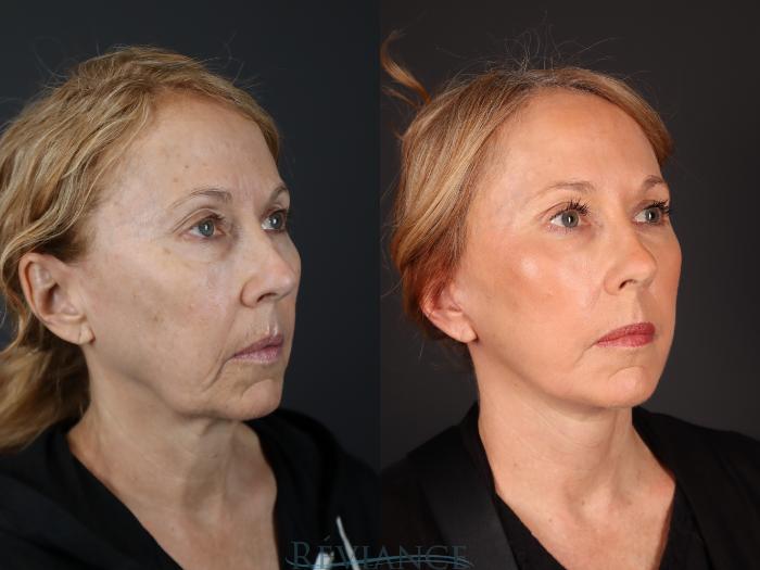 Before & After Facelift Case 2229 3/4 View in Portland, OR
