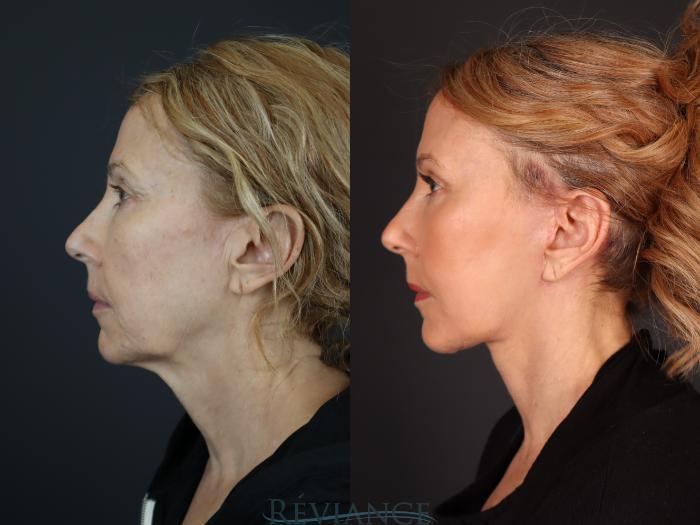 Before & After Facelift Case 2229 Left Side View in Portland, OR