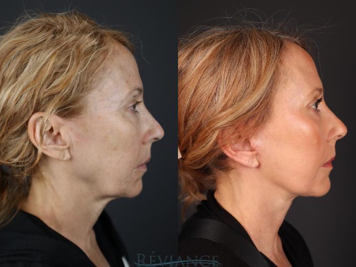 Before & After Facelift Case 2229 Right Side View in Portland, OR