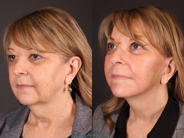Before & After Eyelid Surgery Case 2231 1/4 View in Portland, OR