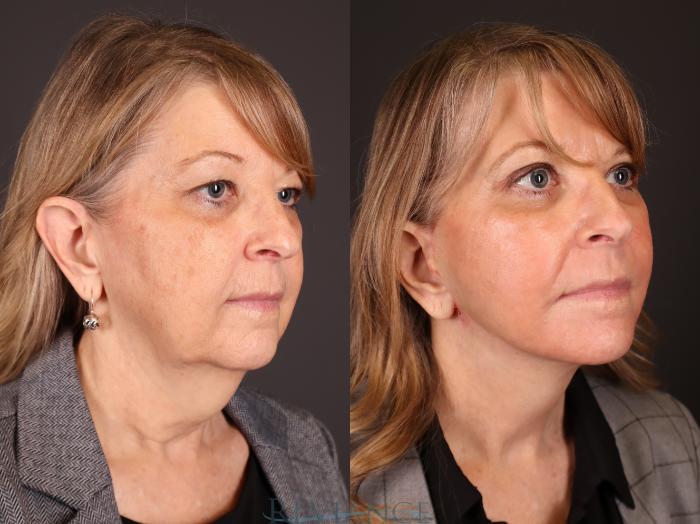 Before & After Eyelid Surgery Case 2231 3/4 View in Portland, OR