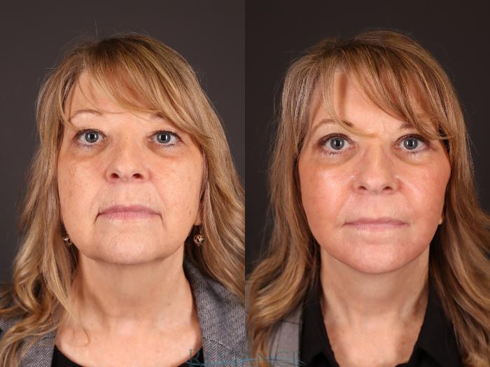 Before & After Eyelid Surgery Case 2231 Front View in Portland, OR
