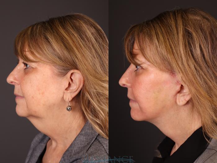 Before & After Eyelid Surgery Case 2231 Left Side View in Portland, OR