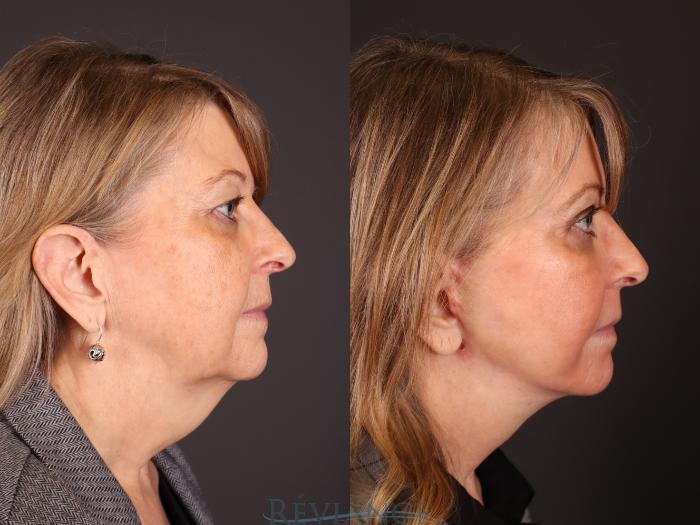 Before & After Eyelid Surgery Case 2231 Right Side View in Portland, OR